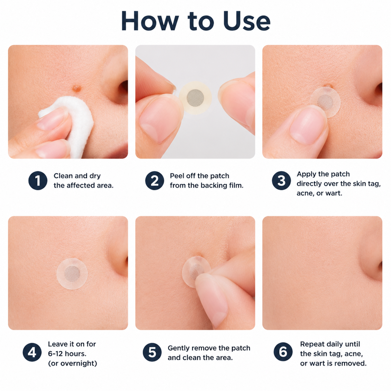 Molescarcure® 2-in-1 Microneedle & Hydrocolloid Patch🍀| Removes Raised Moles, Acne, Flat Warts & Skin Tags