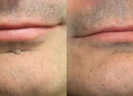 Molescarcure® 2-in-1 Microneedle & Hydrocolloid Patch🍀| Removes Raised Moles, Acne, Flat Warts & Skin Tags