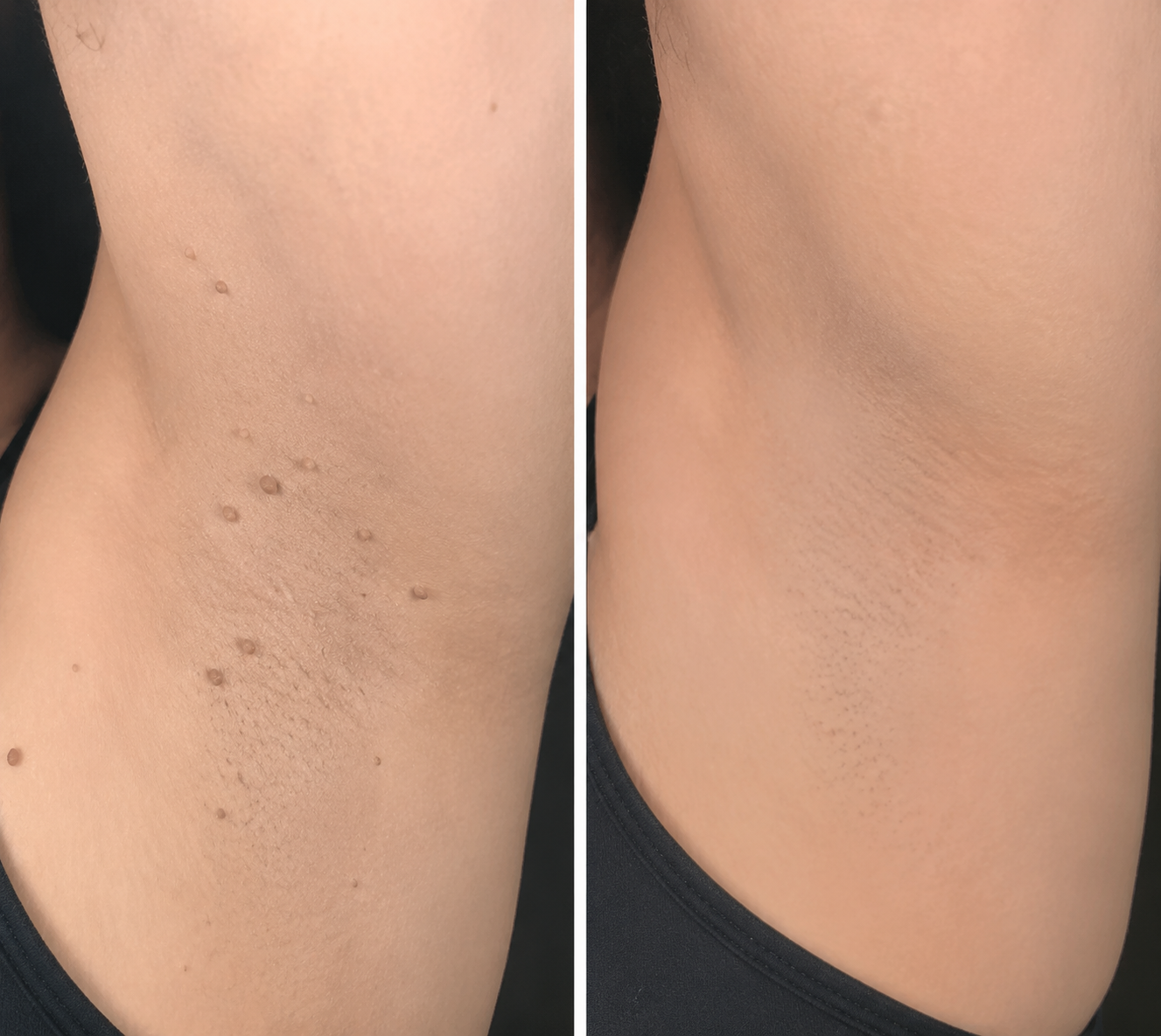 Molescarcure® 2-in-1 Microneedle & Hydrocolloid Patch🍀| Removes Raised Moles, Acne, Flat Warts & Skin Tags