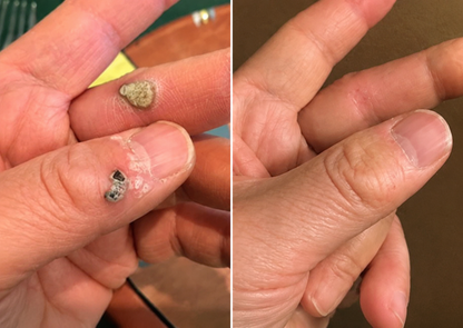 Molescarcure® 2-in-1 Microneedle & Hydrocolloid Patch🍀| Removes Raised Moles, Acne, Flat Warts & Skin Tags